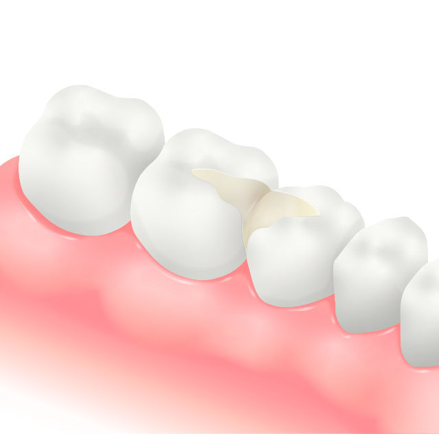 CADCAMインレーのイラスト