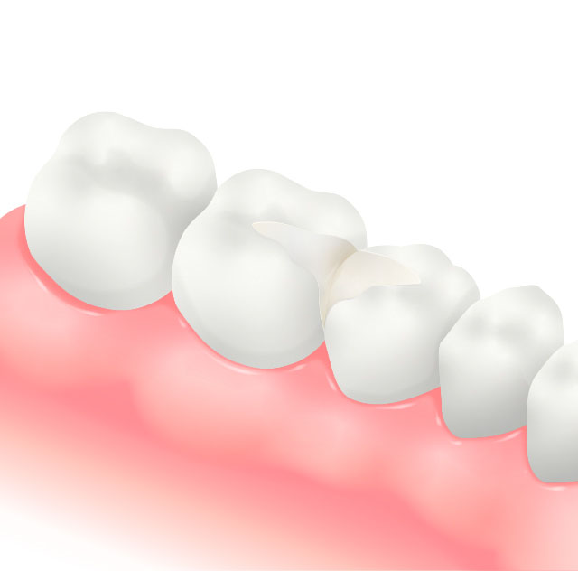 セラミックスインレーのイラスト