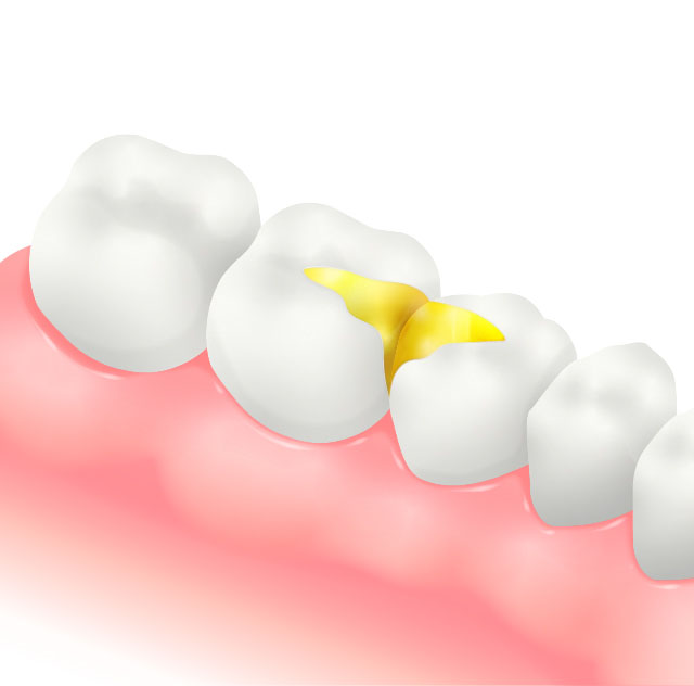 ゴールドインレーのイラスト