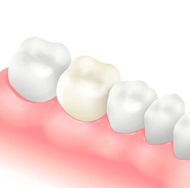 CAD CAM冠のイラスト