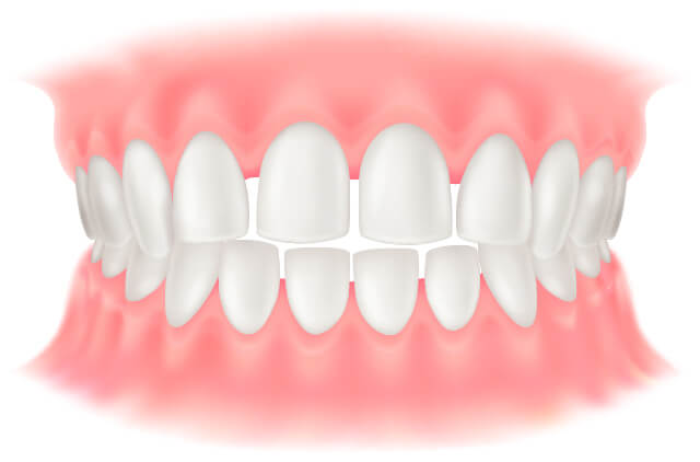 空隙歯列のイラスト