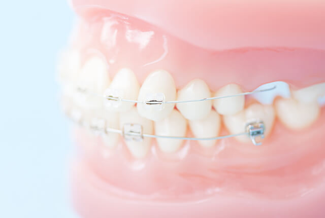 歯と矯正器具の模型