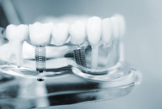 インプラントの模型