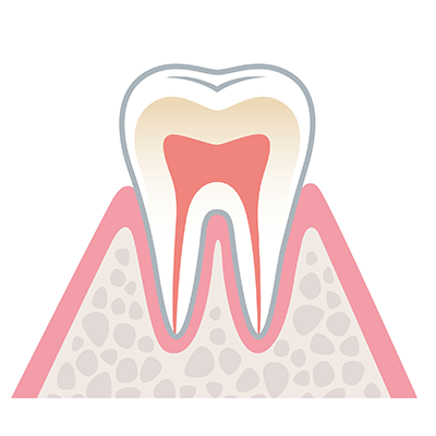 歯周病の進行と症状のイラスト1